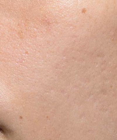 Bellafill Before & After Gallery - Patient 118477 - Image 1