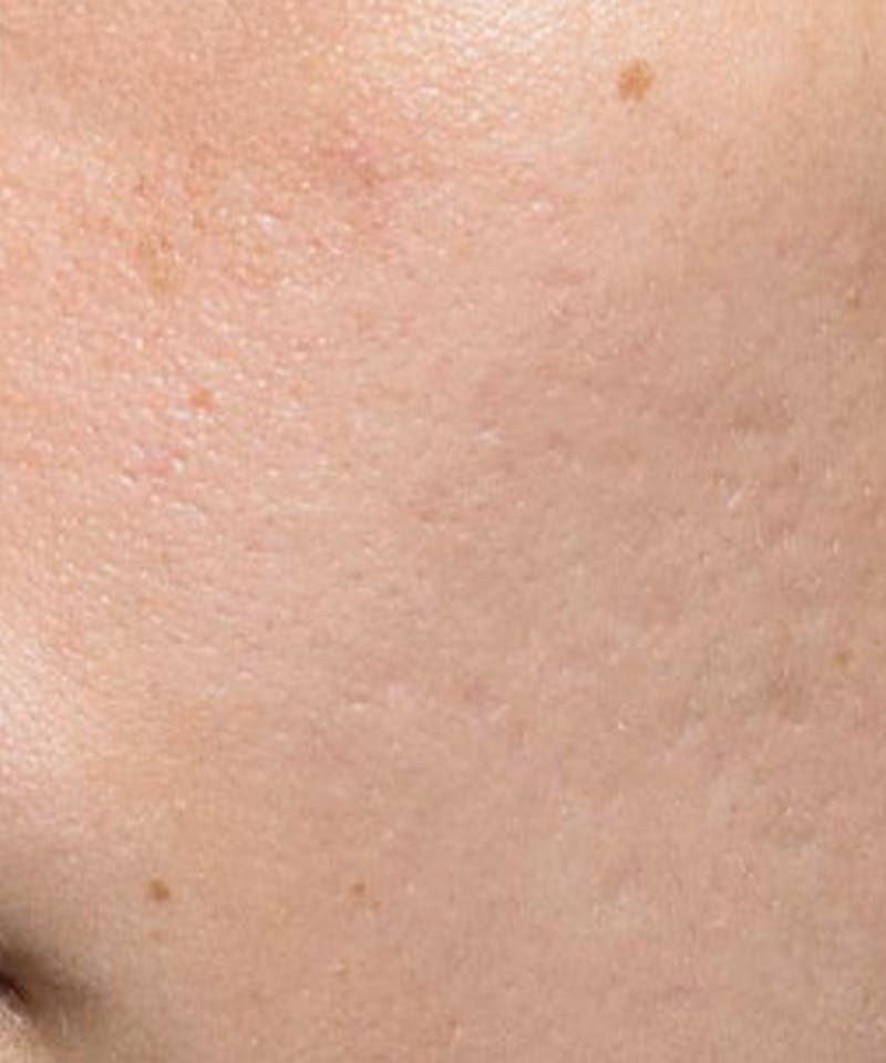 Bellafill Before & After Gallery - Patient 118477 - Image 1