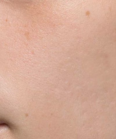 Bellafill Before & After Gallery - Patient 118477 - Image 2