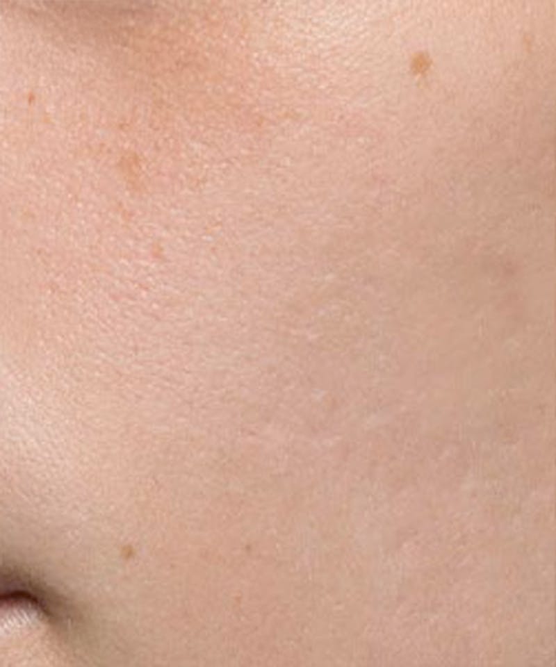 Bellafill Before & After Gallery - Patient 118477 - Image 2