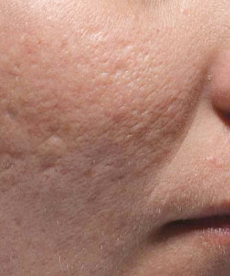Bellafill Before & After Gallery - Patient 381527 - Image 1