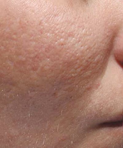 Bellafill Before & After Gallery - Patient 381527 - Image 2