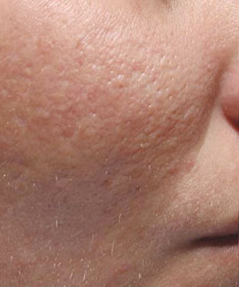 Bellafill Before & After Gallery - Patient 381527 - Image 2