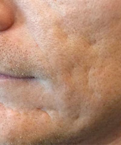 Bellafill Before & After Gallery - Patient 137325 - Image 1