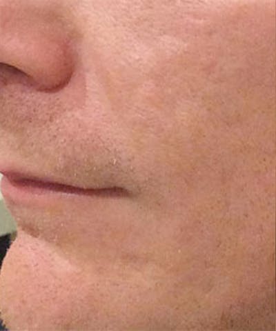 Bellafill Before & After Gallery - Patient 137325 - Image 2