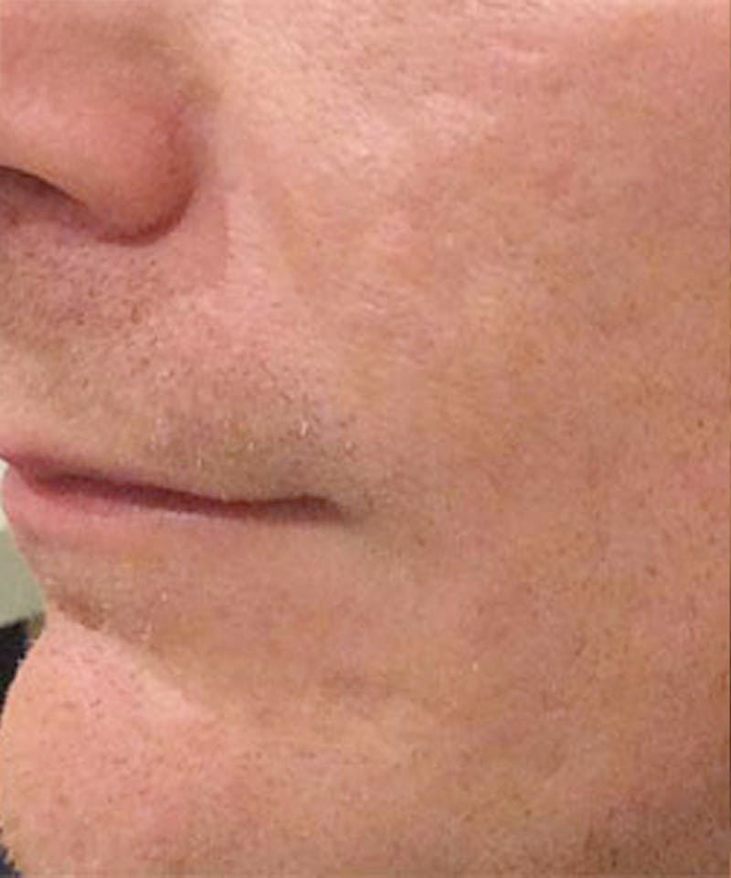 Bellafill Before & After Gallery - Patient 137325 - Image 2