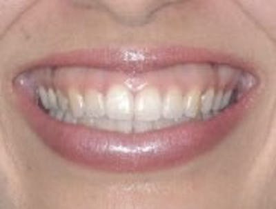 Botox Gummy Smile Correction Before & After Gallery - Patient 138647 - Image 1