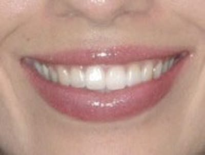 Botox Gummy Smile Correction Before & After Gallery - Patient 138647 - Image 2