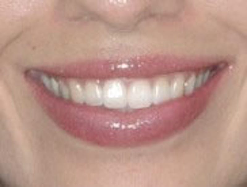 Botox Gummy Smile Correction Before & After Gallery - Patient 138647 - Image 2
