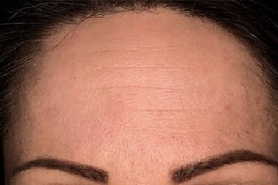 Botox for Wrinkles Before & After Gallery - Patient 281336 - Image 1