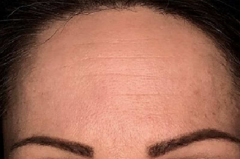 Botox for Wrinkles Before & After Gallery - Patient 281336 - Image 1
