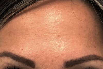 Botox for Wrinkles Before & After Gallery - Patient 281336 - Image 2