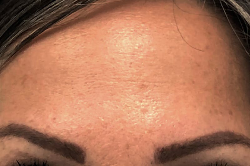Botox for Wrinkles Before & After Gallery - Patient 281336 - Image 2