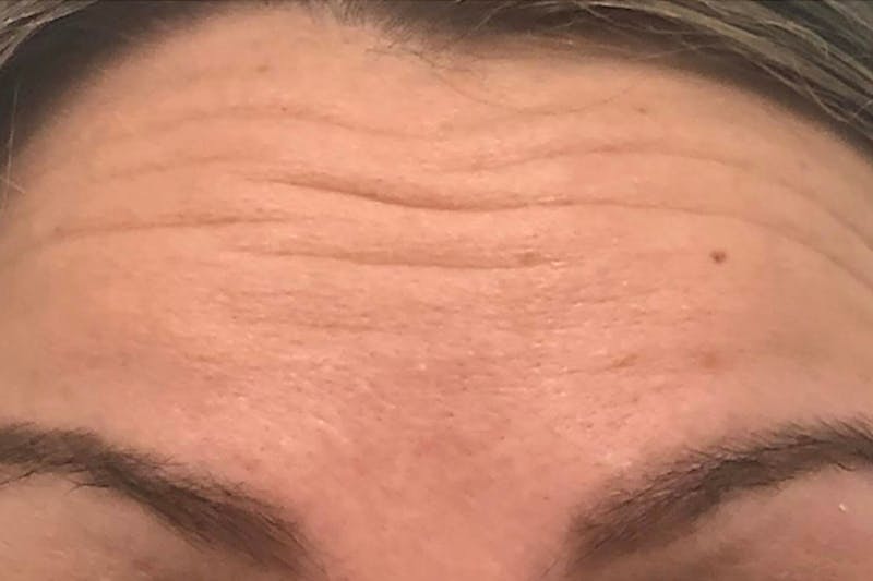 Botox for Wrinkles Before & After Gallery - Patient 358013 - Image 1