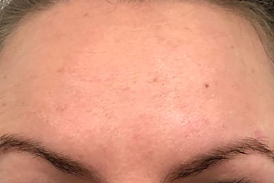 Botox for Wrinkles Before & After Gallery - Patient 358013 - Image 2