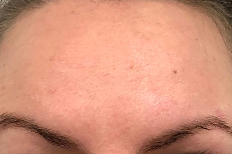 Botox for Wrinkles Before & After Gallery - Patient 358013 - Image 2