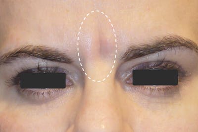 Botox for Wrinkles Before & After Gallery - Patient 229404 - Image 1