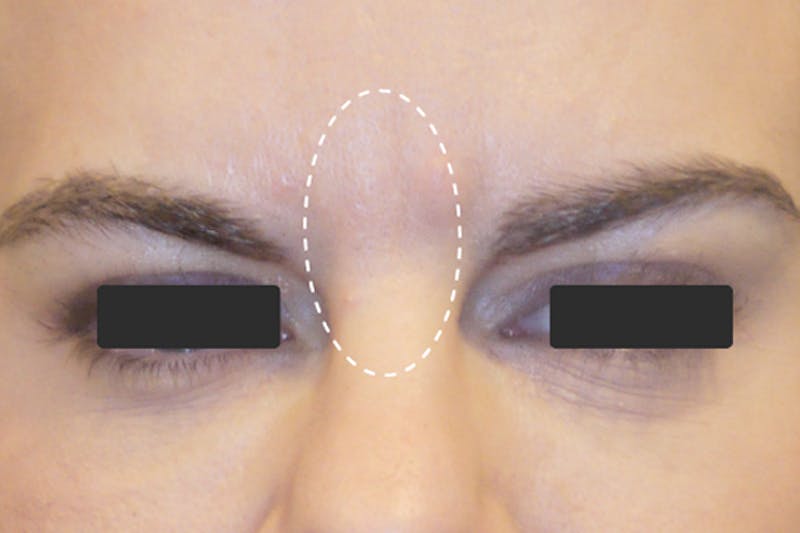 Botox for Wrinkles Before & After Gallery - Patient 229404 - Image 2
