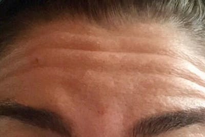 Botox for Wrinkles Before & After Gallery - Patient 241196 - Image 1