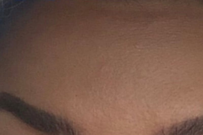 Botox for Wrinkles Before & After Gallery - Patient 241196 - Image 2