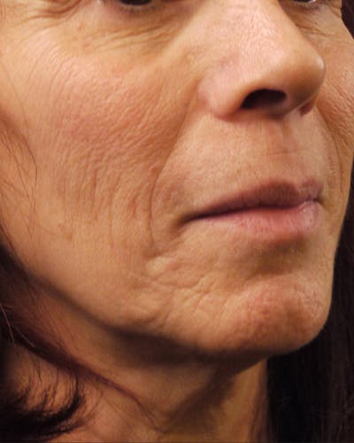 CO2 Laser Resurfacing Before & After Gallery - Patient 454141 - Image 1