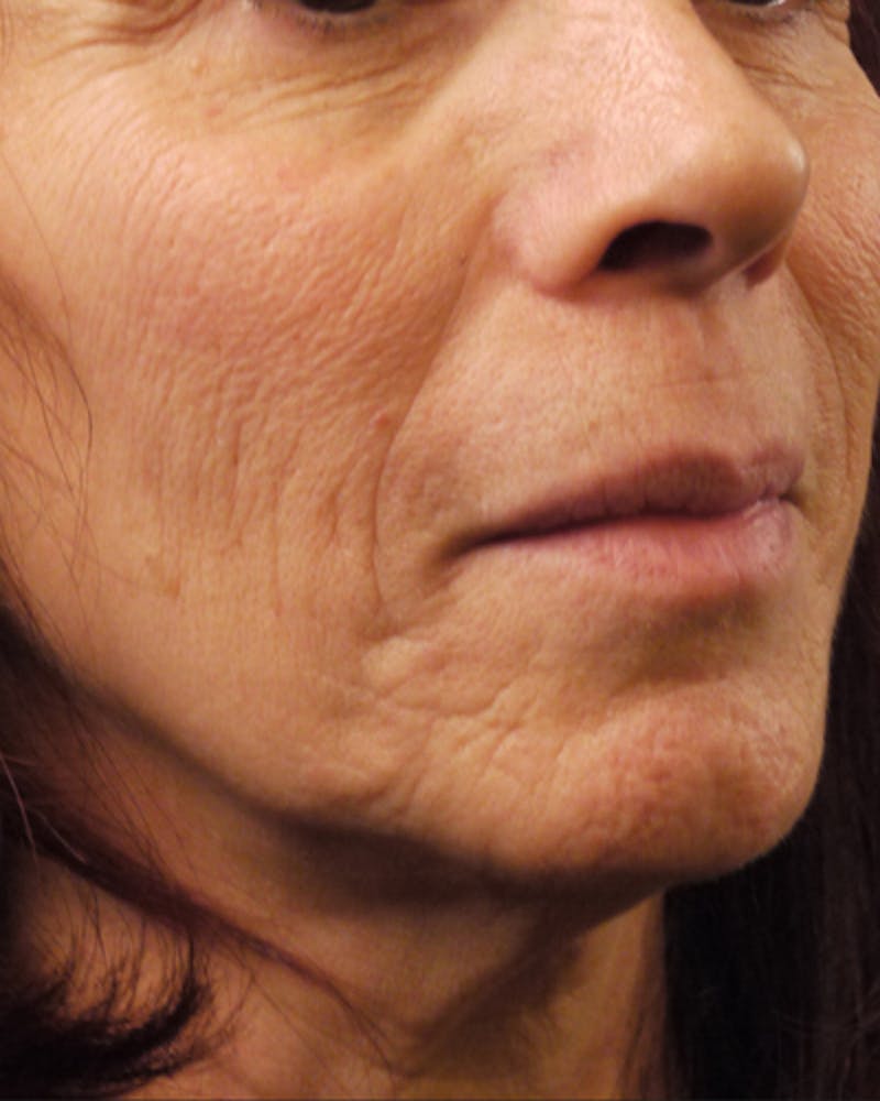 CO2 Laser Resurfacing Before & After Gallery - Patient 454141 - Image 1
