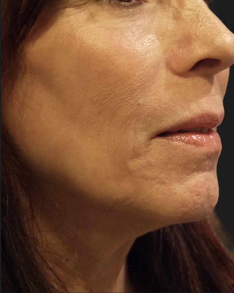 CO2 Laser Resurfacing Before & After Gallery - Patient 454141 - Image 2
