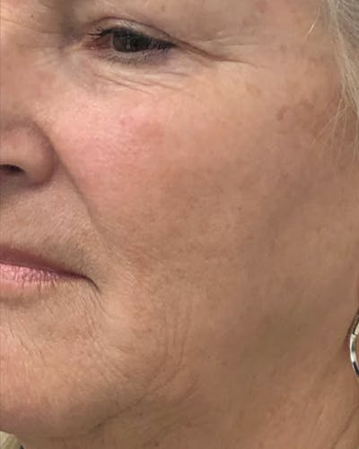 CO2 Laser Resurfacing Before & After Gallery - Patient 238243 - Image 1