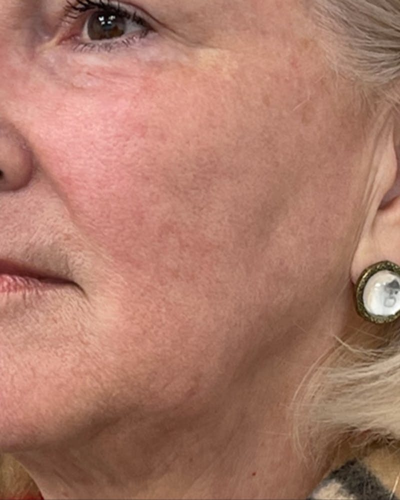 CO2 Laser Resurfacing Before & After Gallery - Patient 238243 - Image 2