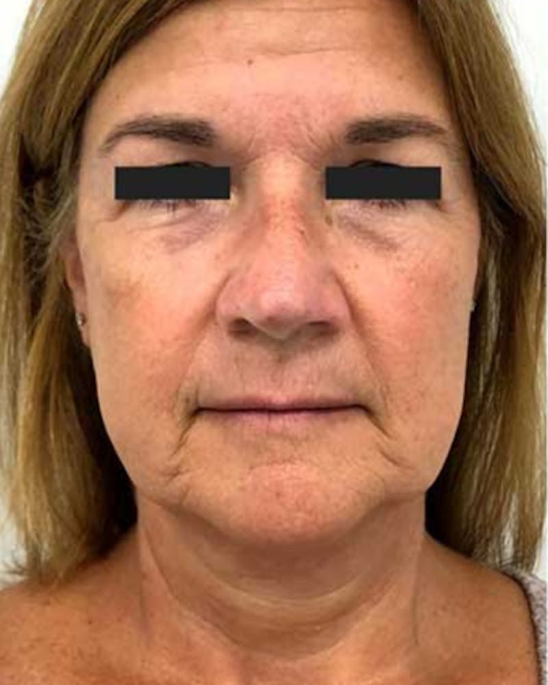 CO2 Laser Resurfacing Before & After Gallery - Patient 193077 - Image 1
