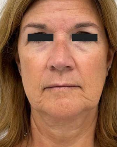 CO2 Laser Resurfacing Before & After Gallery - Patient 193077 - Image 2