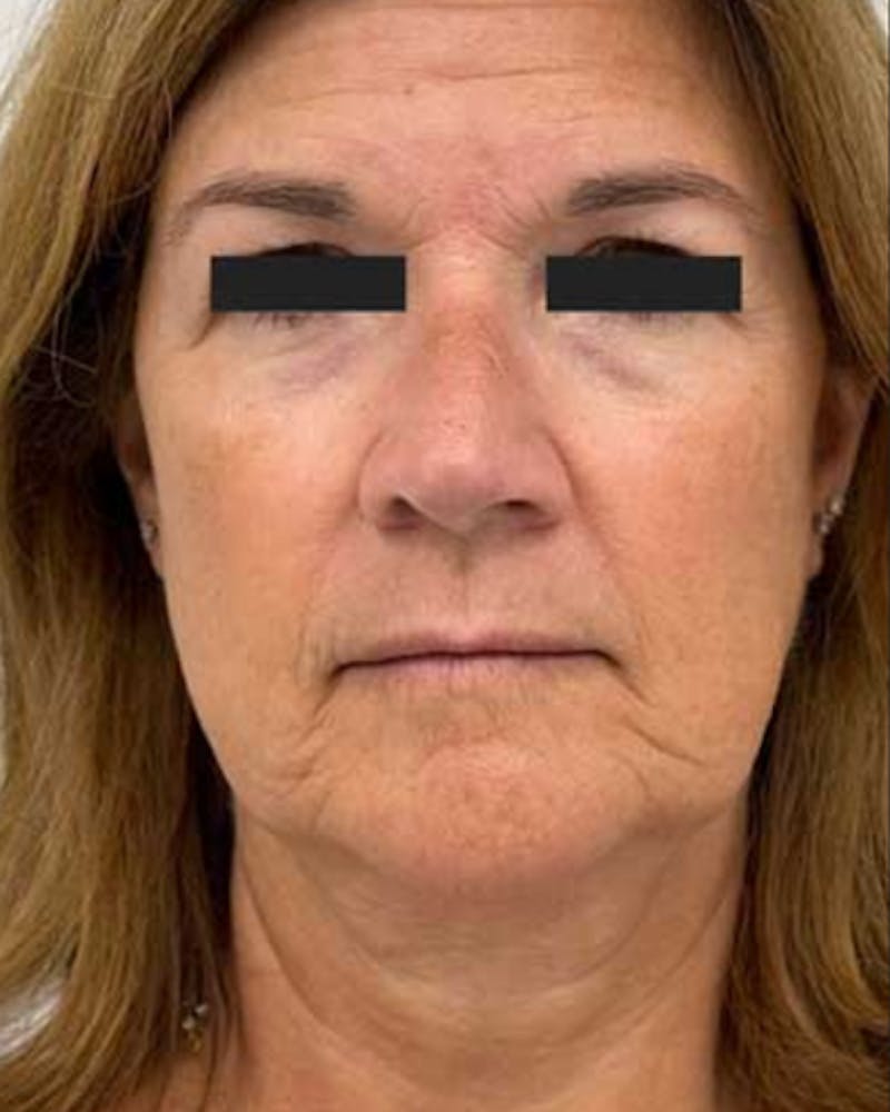 CO2 Laser Resurfacing Before & After Gallery - Patient 193077 - Image 2