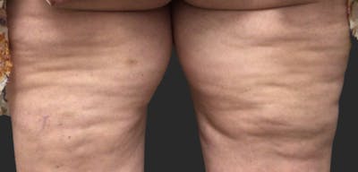 Celllulite Treatment RF Before & After Gallery - Patient 124887 - Image 1