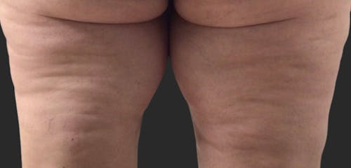 tirzepatide experience Most of what you hear about tirzepatide isn’t wrong… it’s just incomplete.,  Yes, it can reduce appetite. Yes, some people experience nausea. But no, it  doesn’t mean you’ll never feel hungry again or