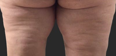 Celllulite Treatment RF Before & After Gallery - Patient 124887 - Image 2