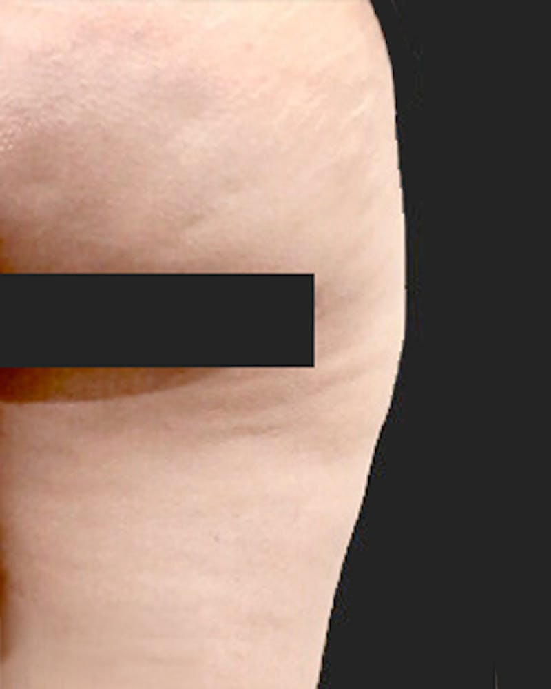 Cellulite Solutions Combo Before & After Gallery - Patient 305449 - Image 1