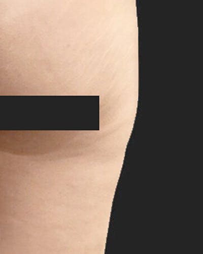 Cellulite Solutions Combo Before & After Gallery - Patient 305449 - Image 2