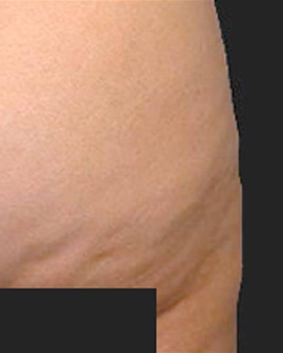 Cellulite Solutions Combo Before & After Gallery - Patient 682161 - Image 1