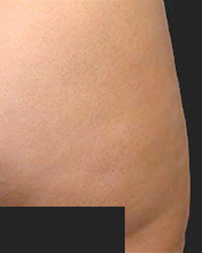 Cellulite Solutions Combo Before & After Gallery - Patient 682161 - Image 2