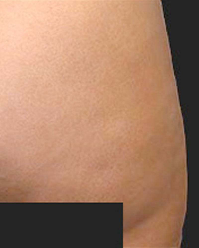 Cellulite Solutions Combo Before & After Gallery - Patient 682161 - Image 2