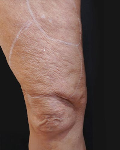 Cellulite Solutions Combo Before & After Gallery - Patient 682805 - Image 1