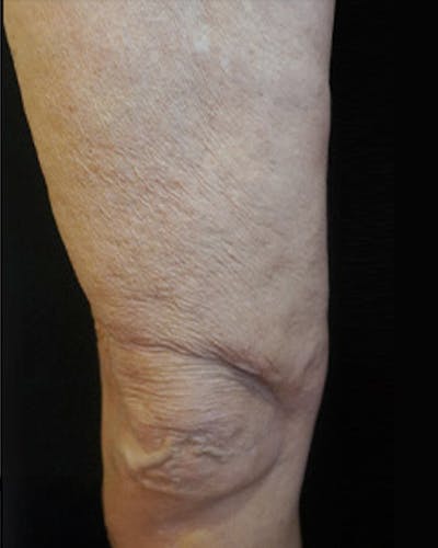 Cellulite Solutions Combo Before & After Gallery - Patient 682805 - Image 2