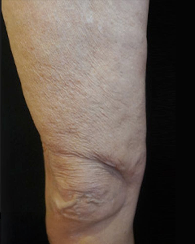 Cellulite Solutions Combo Before & After Gallery - Patient 682805 - Image 2