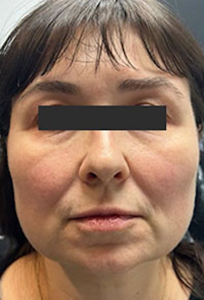 Cheek Fillers Before & After Gallery - Patient 218980 - Image 1