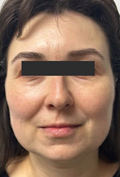 Cheek Fillers Before & After Gallery - Patient 218980 - Image 2