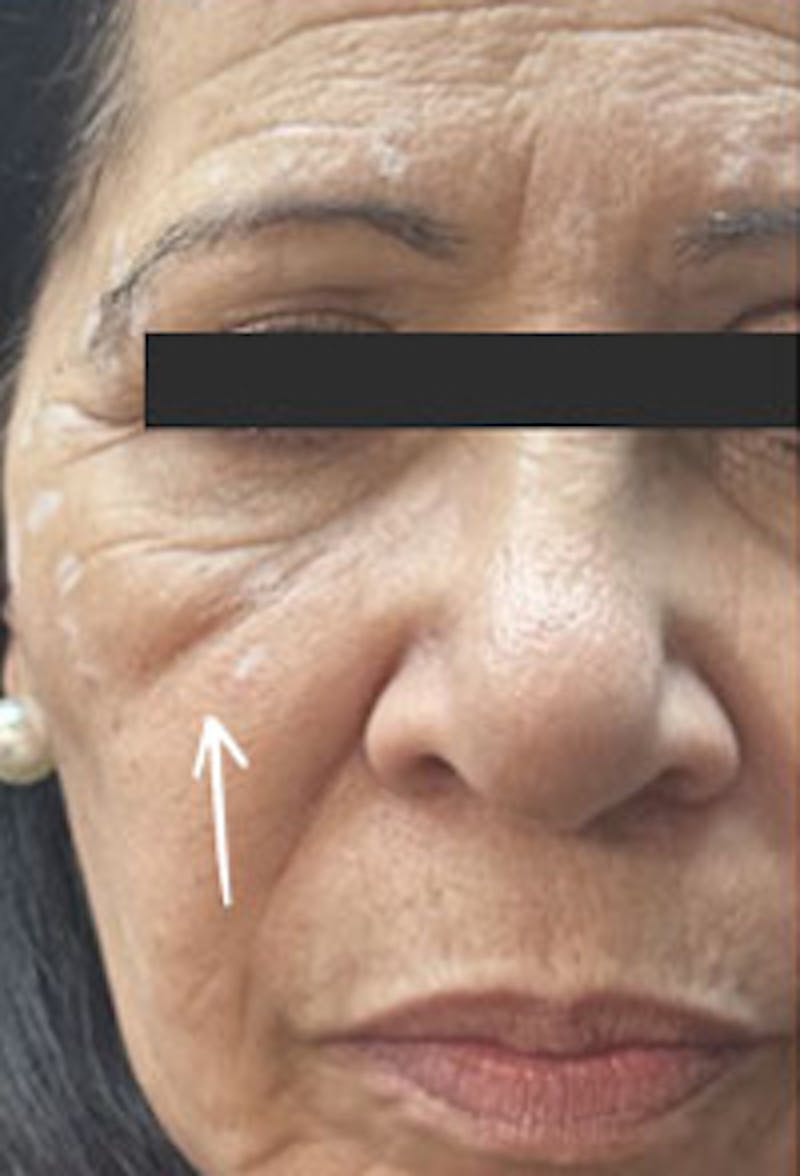 Cheek Fillers Before & After Gallery - Patient 307456 - Image 1