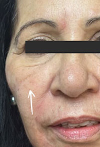 Cheek Fillers Before & After Gallery - Patient 307456 - Image 2