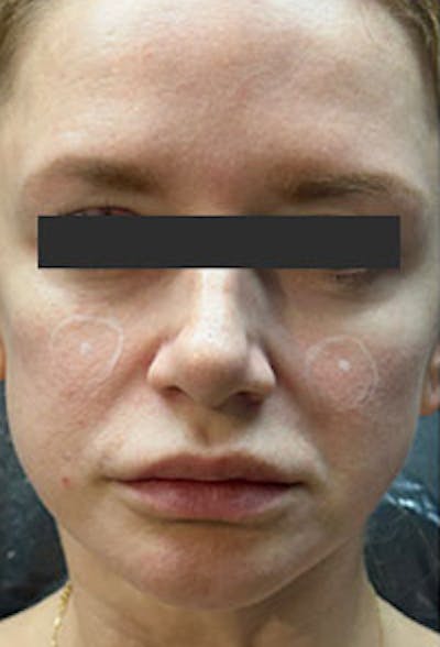 Cheek Fillers Before & After Gallery - Patient 386502 - Image 1