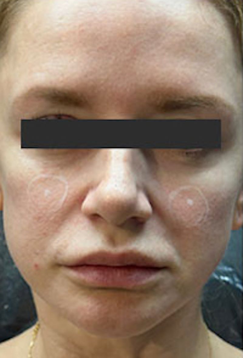 Cheek Fillers Before & After Gallery - Patient 386502 - Image 1