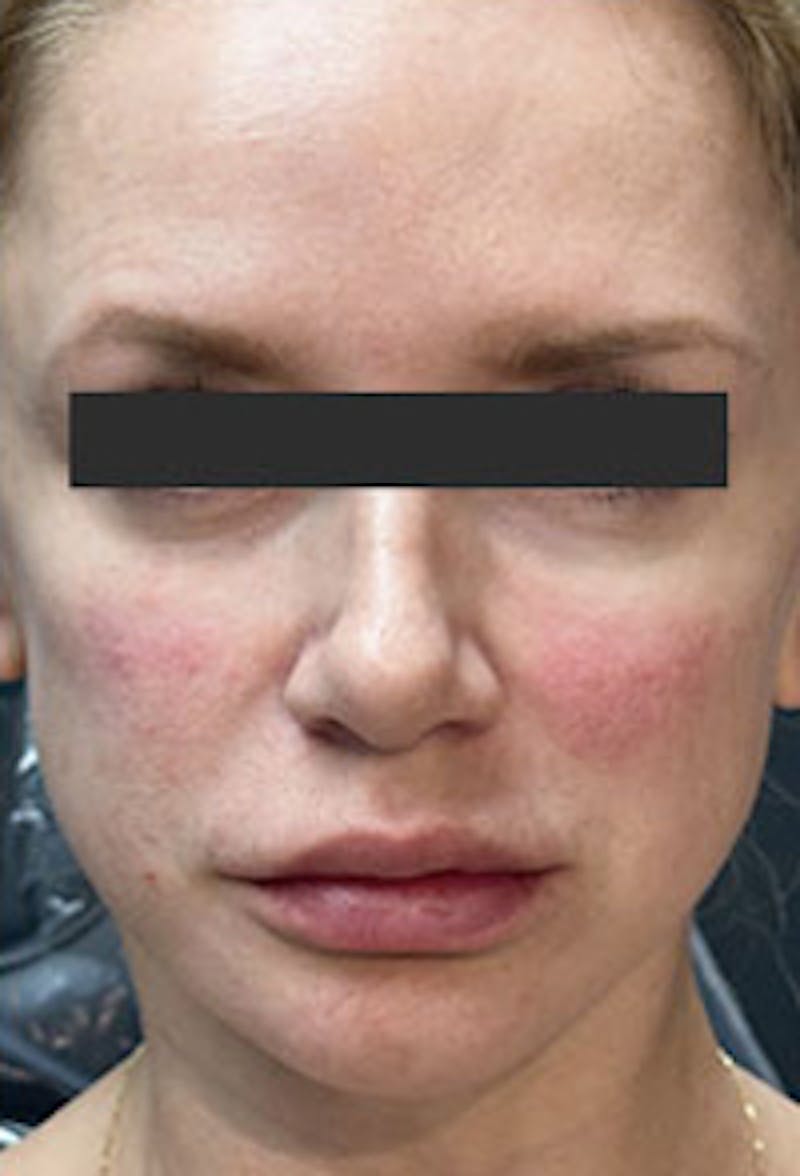 Cheek Fillers Before & After Gallery - Patient 386502 - Image 2